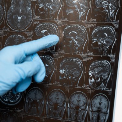 Cropped view of doctor pointing on magnetic resonance imaging of brain isolated on white, alzheimer