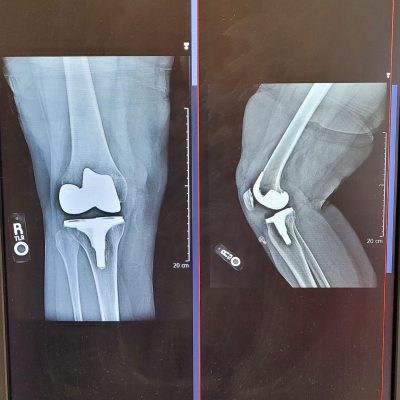 xray-orthopedic-surgery-full-knee-joint-replacem-2022-08-01-01-24-06-utc